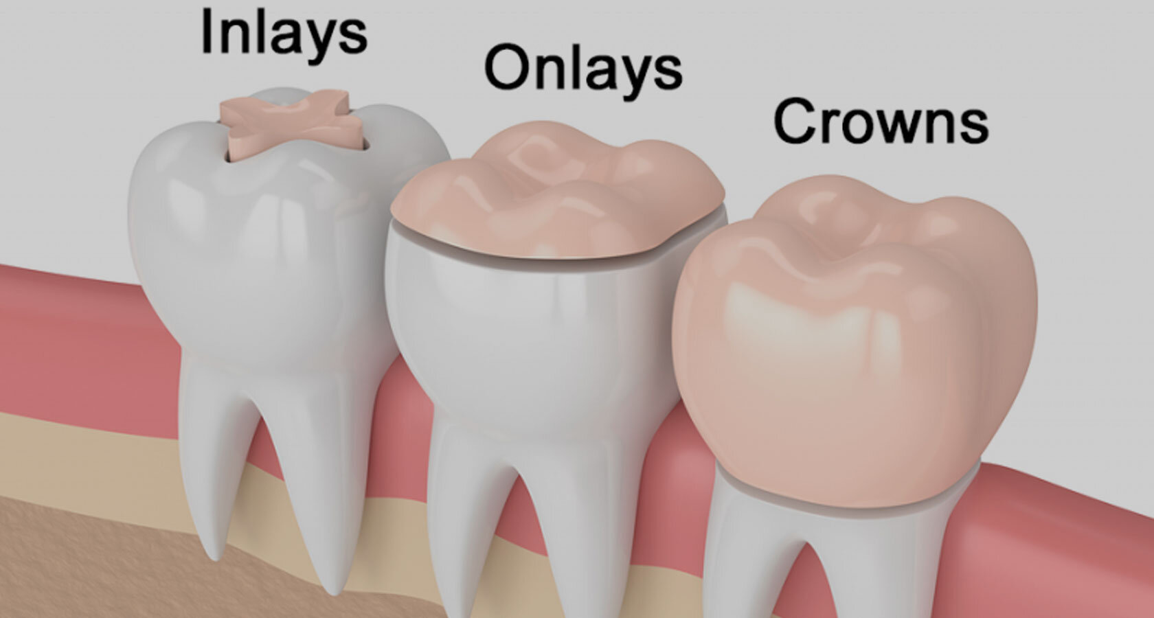 Inlays & Onlays Goldthorn Dental Practice